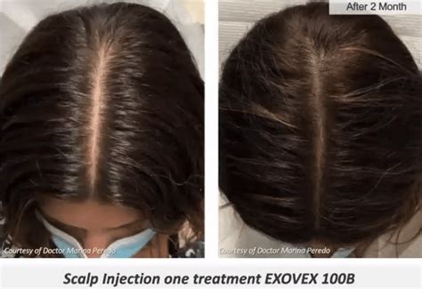 Exovex Exosomes Hair Rejuvenation Jennifer L Walden