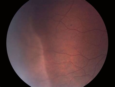 white  pressure retina image bank