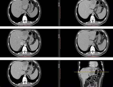 Hemangioma Hep Tico Diagnostico Org