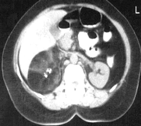 Computed Tomography Scan Showing A Large Adrenal Tumor Having Fatty