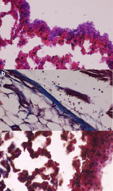 Fibrosis Scale With Masson Trichrome Staining Technique A C A Mild