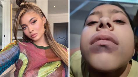 Kylie Jenner Lip Challenge leads to girl’s shock diagnosis | 7NEWS