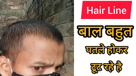 Bahut Jada Baal Gir Raha Hai How To Stop Receding Hair Line And Hair