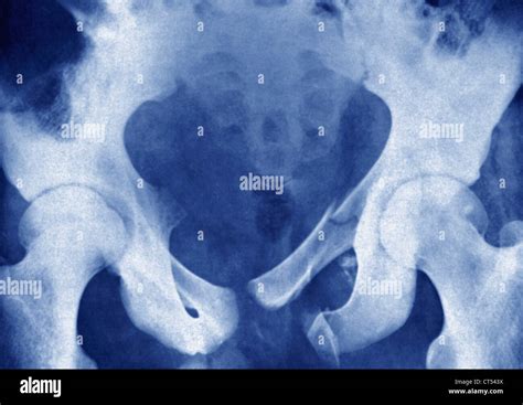 Pubic bone hi-res stock photography and images - Alamy