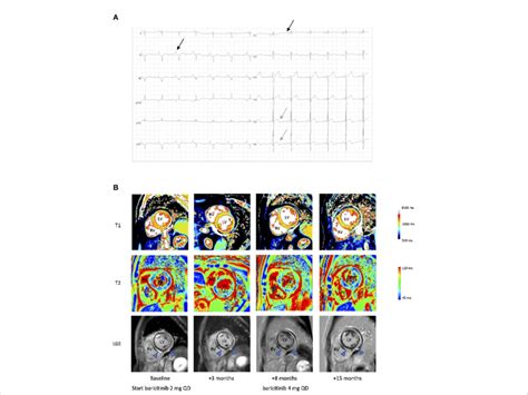 Electrocardiographic And Radiological Findings In A Patient With Stat