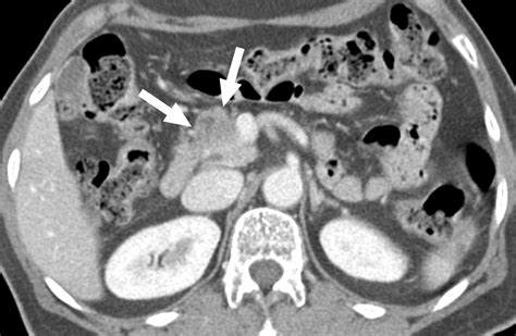 Focal Fatty Replacement Of The Pancreas Usefulness Of Chemical Shift