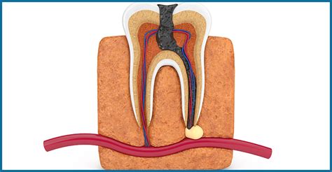 Condensing Osteitis: Symptoms, Diagnosis and Management - Oris Dental ...