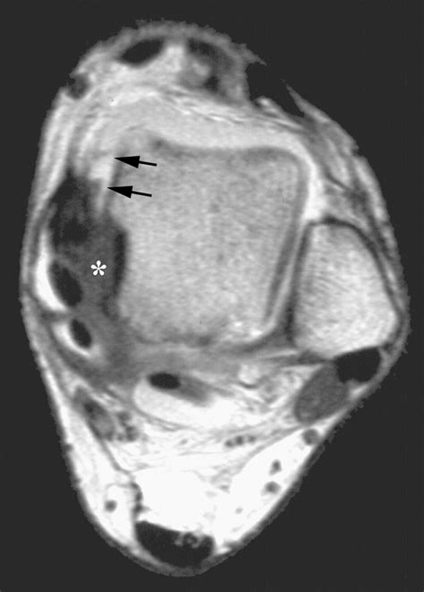 Mr Imaging Of Ankle Impingement Syndromes Ajr