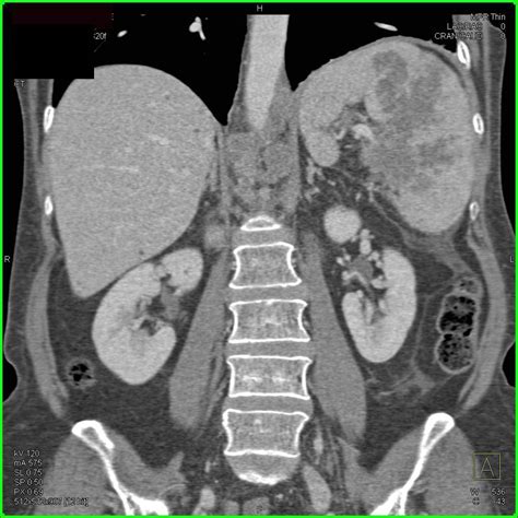 Lymphoma Involves The Spleen Liver And Para Aortic Adenopathy Spleen