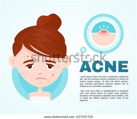 Acne Infographic Vector Modern Flat Style Stock Vector Royalty Free