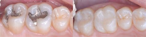 Composite Fillings Carntyne Dental Care