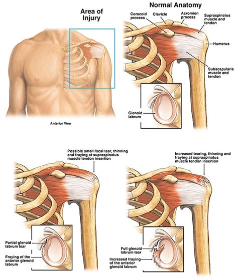 Average Settlement For Shoulder Injury Car Accident Desmond Ruhl