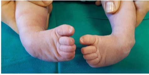 What is Clubfoot - Diagnosis and Treatment