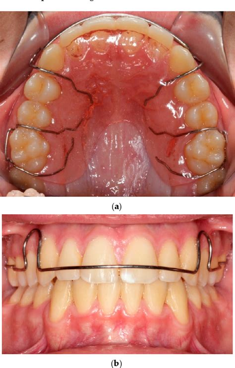 Figure 1 From Orthodontic Retainers—a Critical Review Semantic Scholar