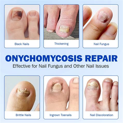 Fungal Nail Patches (21 PCS) - trendychop1