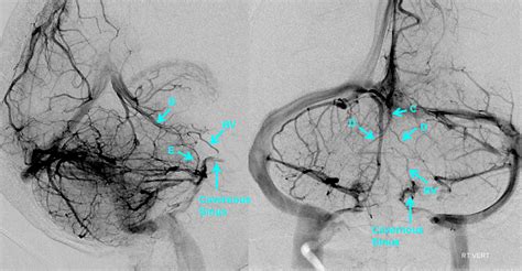 Bridging Vein (anterior brainstem group) | neuroangio.org