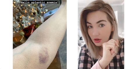 90 Day Fiancé Stephanie Matto Shares Shocking Pics Of Rare Health