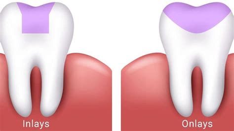 What Are Dental Inlays And Onlays? - Dr Jamilian