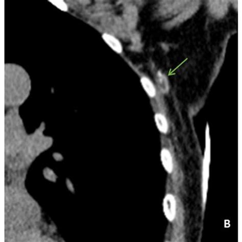 Representative Multidetector Row Computed Tomography Lymphography