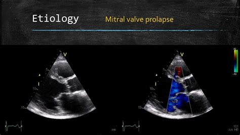 Echocardiography of Mitral regurgitation