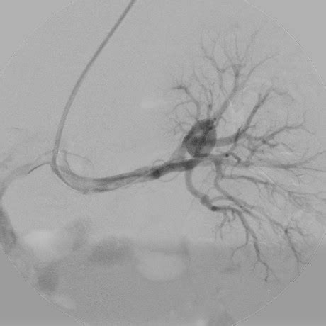 Digital Subtraction Angiography Selective Left Renal Injection Through