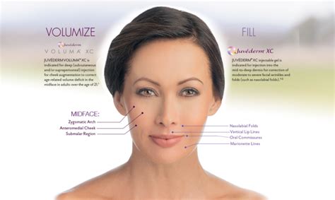 Juvederm Voluma for Youthful, Contoured Cheeks - San Diego Cosmetic ...