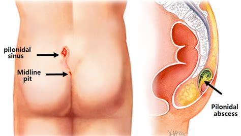 Pilonidal Cyst Diagram