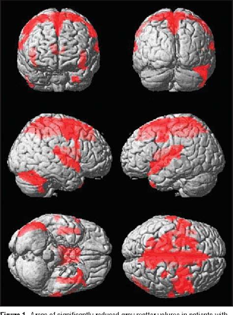 Figure 1 From Association Of Ideomotor Apraxia With Frontal Gray Matter