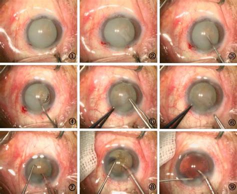 Capsulorhexis for hypermature cataract without staining ① Hypermature