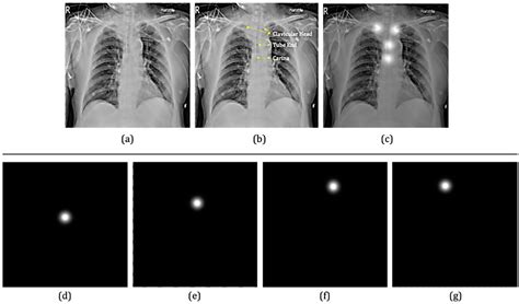 Carina Lung Xray