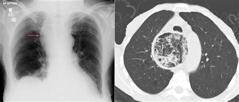 Achalasia - CXR and CT - Radiology at St. Vincent's University Hospital