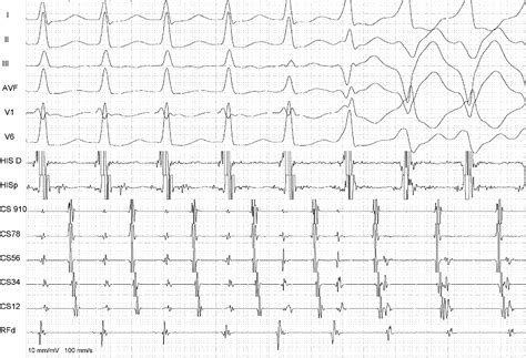 Narrow To Wide Qrs Tachycardia What Is The Mechanism Heart Rhythm