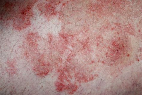 Quality Of Life In Atopic Dermatitis Improved With Novel Biologic Medication