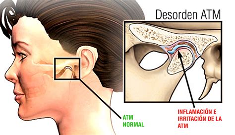 Dolor de oído y mandíbula derecha Normalweb es