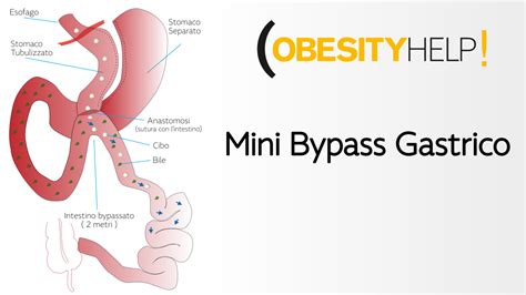 Mini Bypass Gastrico Obesityhelp