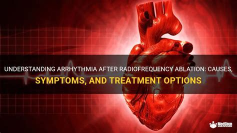 Understanding Arrhythmia After Radiofrequency Ablation Causes Symptoms And Treatment Options