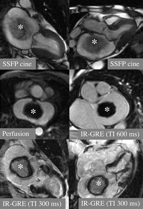 Noninvasive Characterization Of Left Atrial Mass Circulation