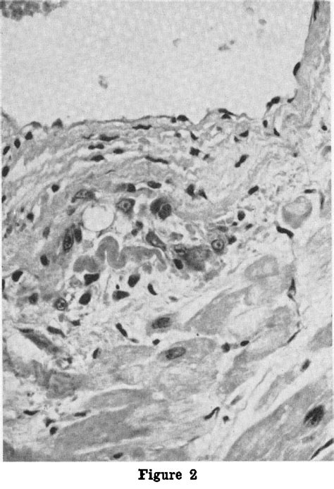 Figure 2 from The Frequency of Aschoff Bodies in Atrial Appendages of Patients with Mitral ...