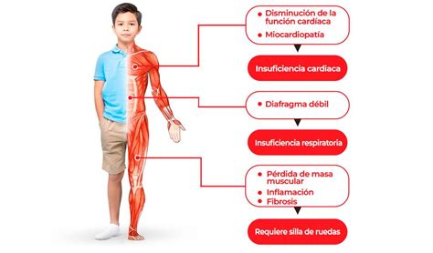 Atrofia Muscular De Duchenne - Día Mundial de la Distrofia Muscular de Duchenne: la clave está en ...