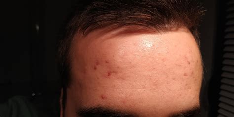 [Skin concerns] Red spots on forehead : r/SkincareAddiction