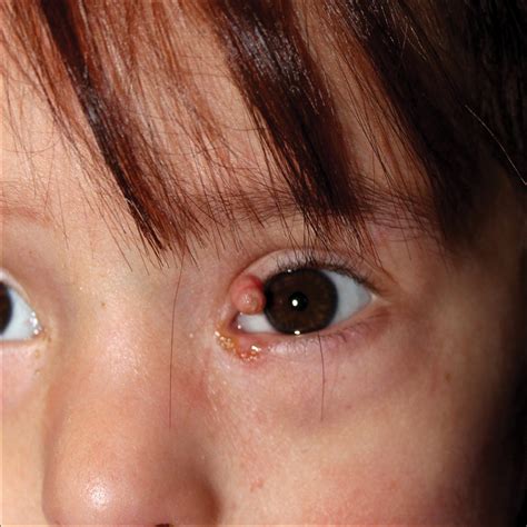 A Rare Association In Down Syndrome Milialike Idiopathic Calcinosis