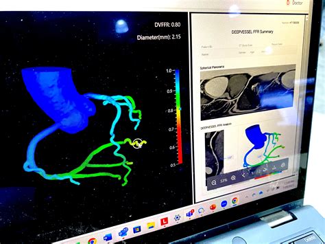 Reimbursement expected to drive implementation of CCTA, coronary plaque