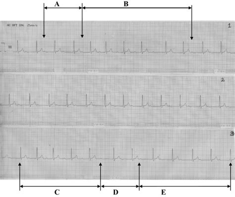 1st Degree Heart Block Rhythm Strip - Photos Idea