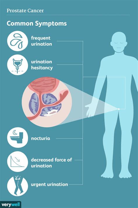 Enlarged Prostate Overview And More