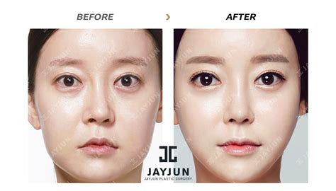 Nose Surgery In Korea Rhinoplasty Revision In South Korea Korea Nose