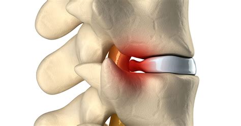 Radiculopathy - Atlanta, GA - Spine Surgery