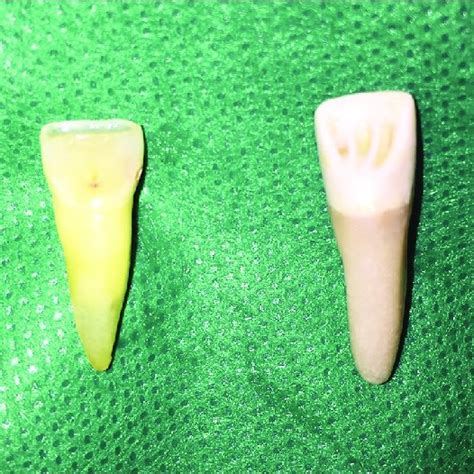 Maxillary central incisor radiograph. | Download Scientific Diagram