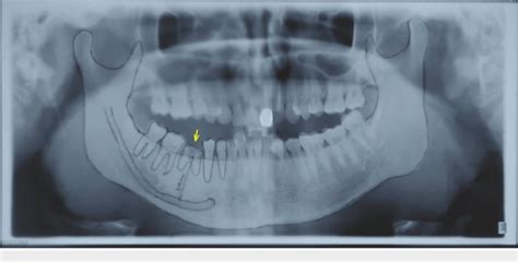 Figure From Graftless Immediate Dual Implant Anatomic Placement With