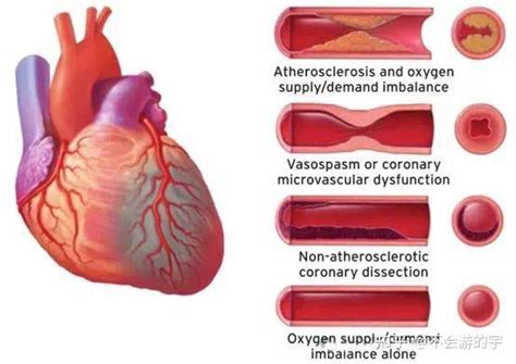 急性心肌梗死的分型和分期 知乎