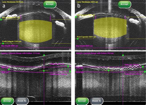 Optical Coherence Tomography Images Of The Right A And The Left B